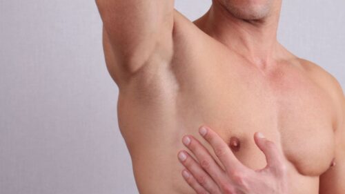 Ginecomastia