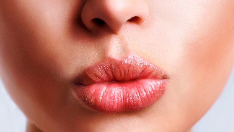 Rimodellamento Labbra Mediante Filler